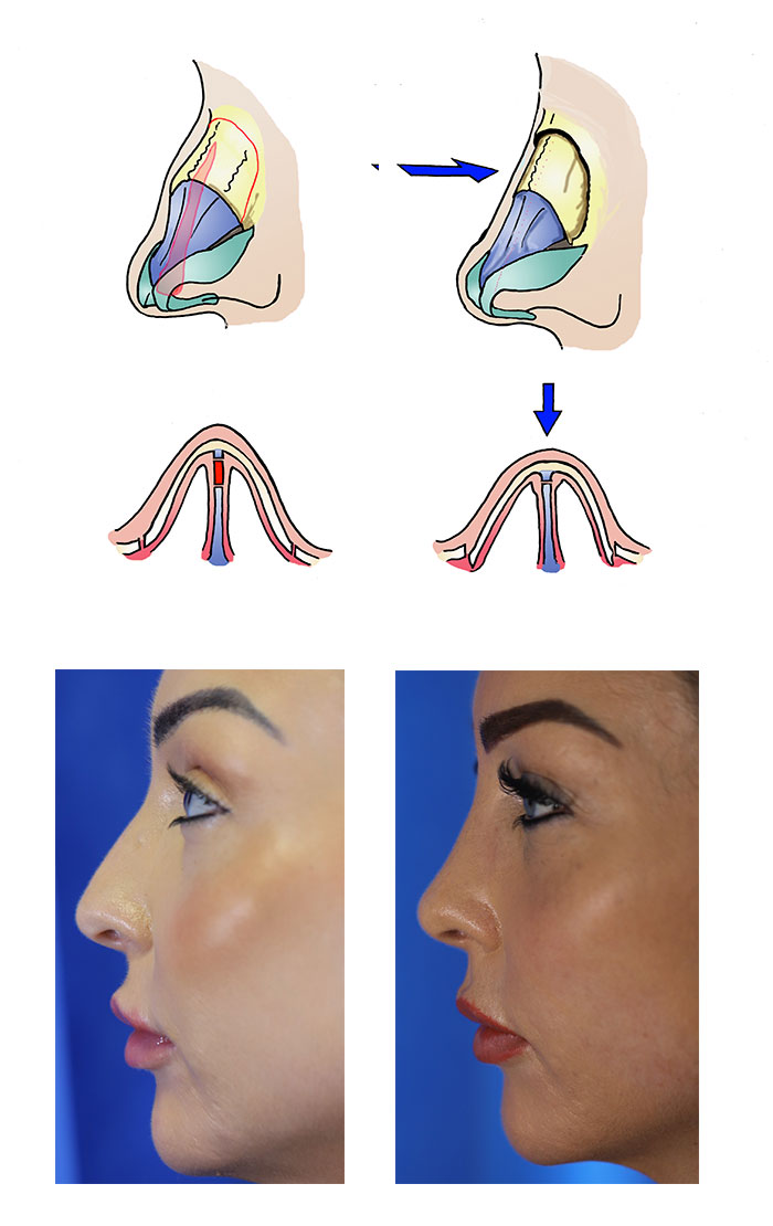 Rhinoplasty (Nose Job) Surgery Procedure